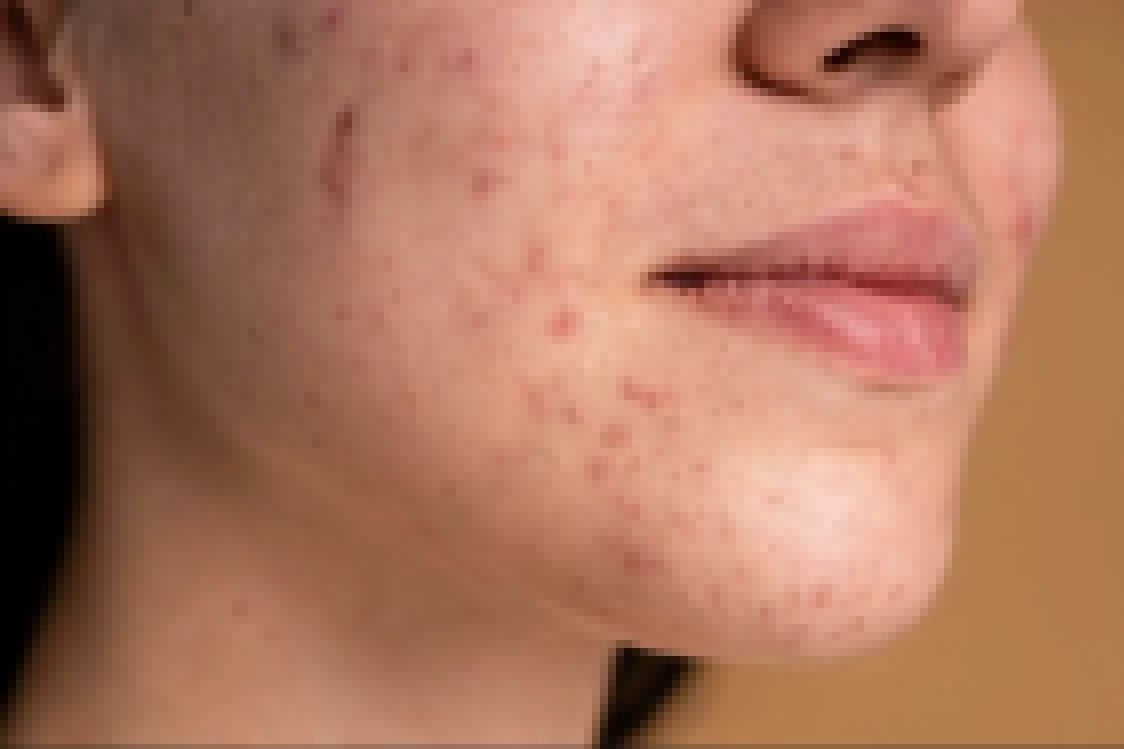 SP busca voluntários para projeto que testa eficácia de tratamento para acne