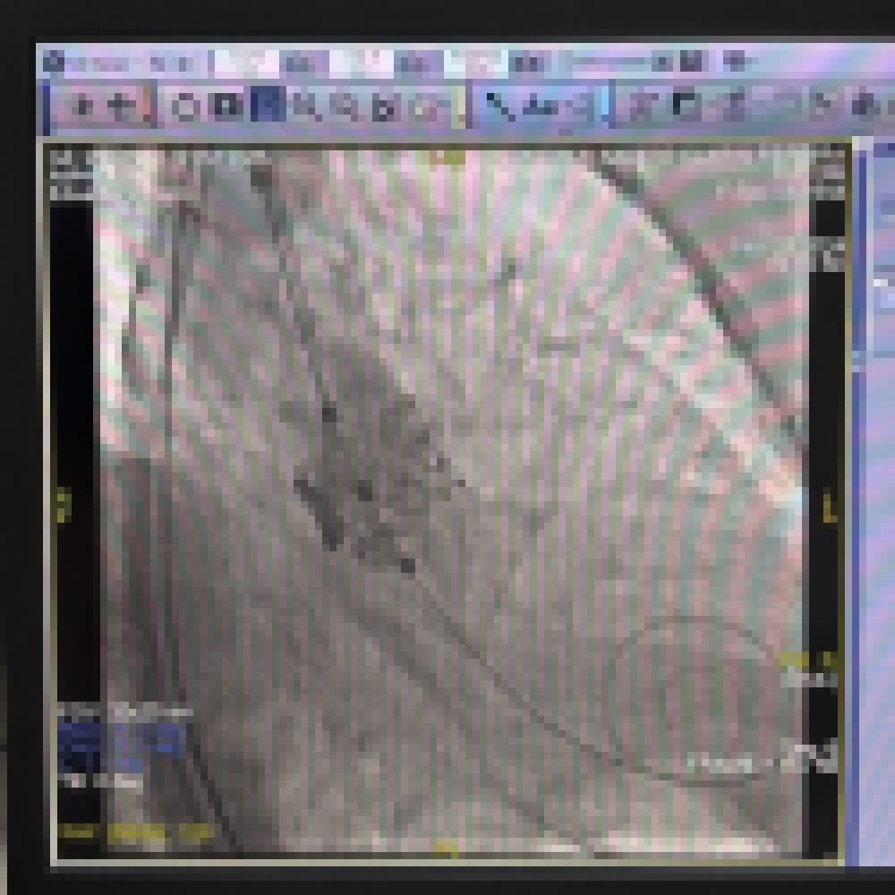 Sorocaba passa a contar com um espaço amplamente capacitado para a realização do procedimento de Implante Transcateter de Válvula Aórtica (TAVI) (1).jpeg