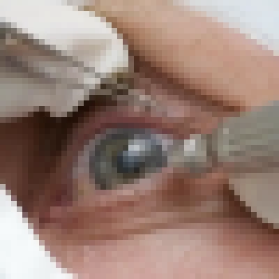 Cirurgia que altera cor do olho tem uso restrito para pessoas cegas