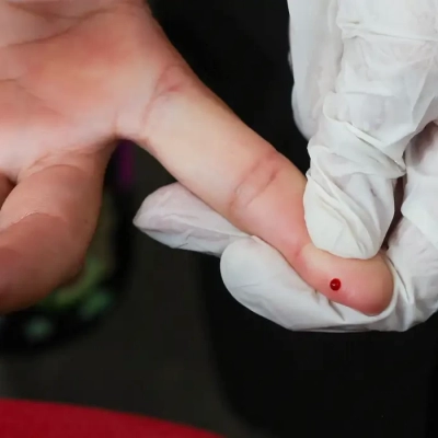 Teste rápido de dengue passa a integrar tabela do SUS