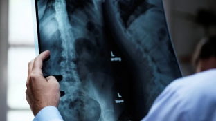 Osteoporose atinge homens e mulheres de maneira diferente; veja cuidados