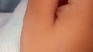O que é a “sarna humana”? Doença de pele tem preocupado pais de alunos do CEI 80 no parque Vitória Régia